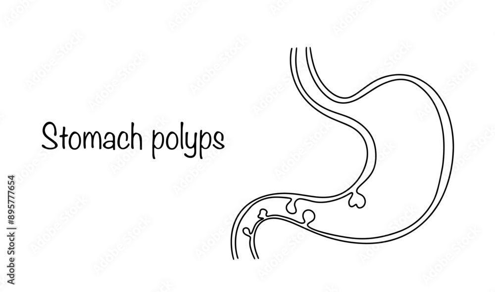 Stomach polyps Stomach polyps