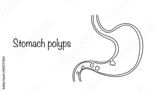 Stomach polyps
