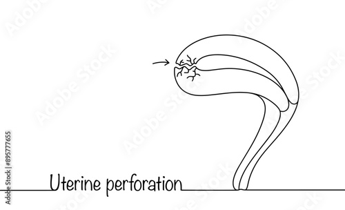Uterine perforation
