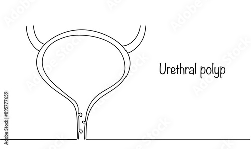 Urethral polyp