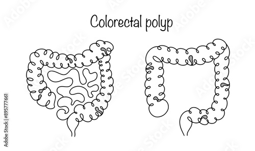 Colorectal polyp