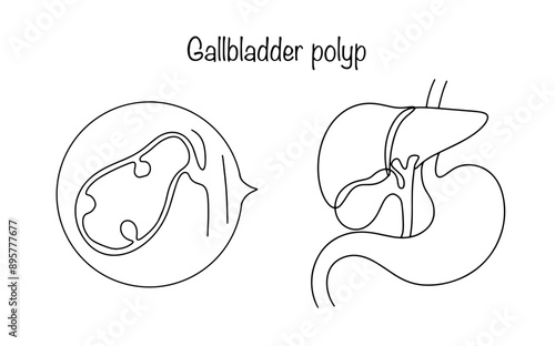 Gallbladder polyp