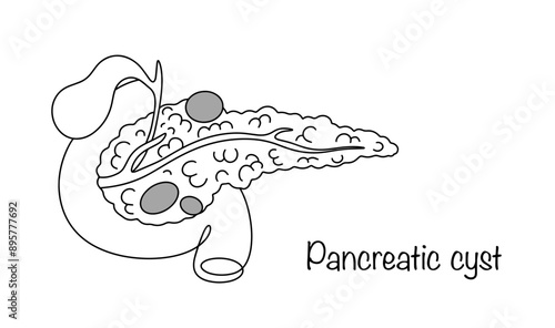 Pancreatic cyst