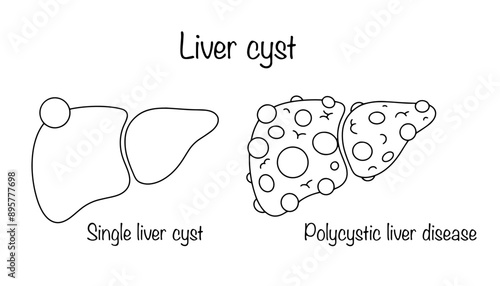 Liver cyst