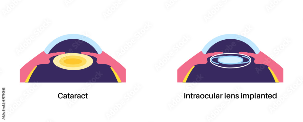 Intraocular lenses poster Intraocular lenses poster