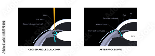 Iridectomy medical poster