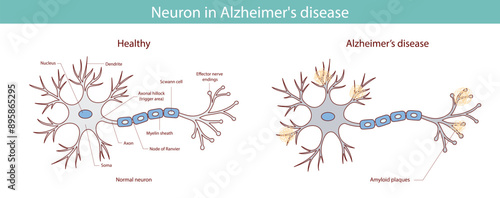 Illustration of neuronal anatomy in Alzheimer's disease. Vector infographics