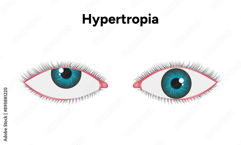 Eye problem disease strabismus Hypertropia Eye problem disease strabismus Hypertropia