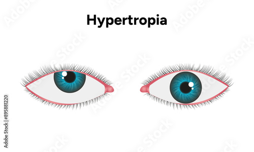 Eye problem disease strabismus Hypertropia