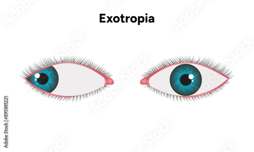 Eye problem disease strabismus Exotropia 