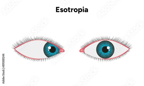 Eye problem disease strabismus Esotropia 