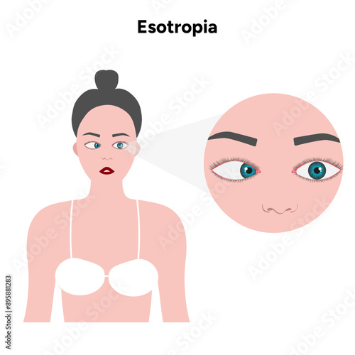 Eye problem disease strabismus Esotropia