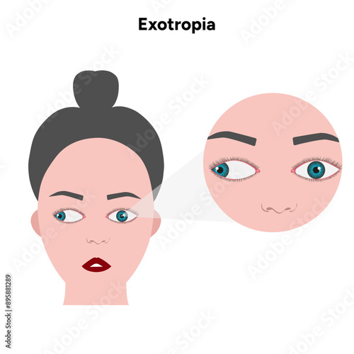 Eye problem disease strabismus Exotropia