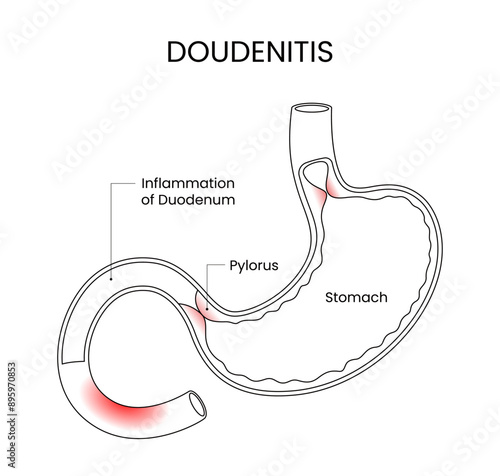 Diagram of the Duodenitis Sketch