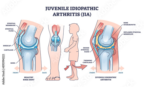 Juvenile idiopathic arthritis or JIA anatomical explanation outline diagram, transparent background. Labeled educational medical scheme with healthy and diseased joint comparison illustration.