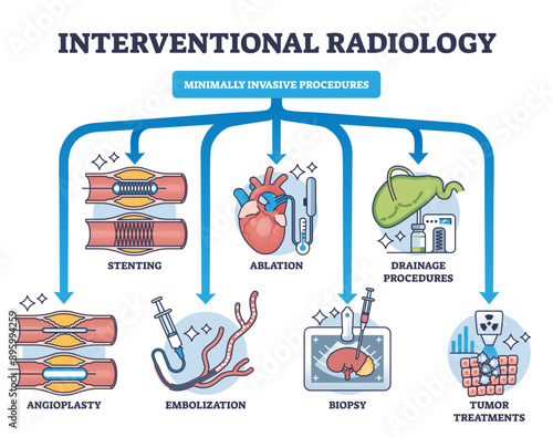Interventional radiology as minimally invasive procedures outline diagram, transparent background. Labeled educational scheme with medical biopsy treatment process for tumors.