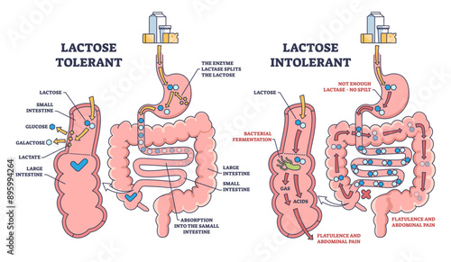 Lactose intolerance and tolerance medical process differences outline diagram, transparent background. Labeled educational anatomical digestive tract splitting explanation.