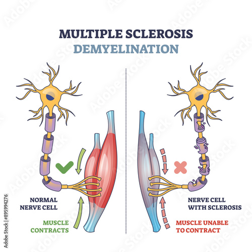 Multiple sclerosis demyelination compared with medical healthy nerves outline diagram, transparent background. Labeled educational scheme.