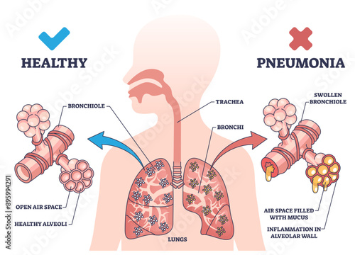Pneumonia illness medical comparison with healthy lungs outline diagram, transparent background. Respiratory system problem with bronchi wall inflammation and air filled with mucus illustration.