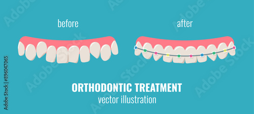 Orthodontic treatment result, before and after. Crooked teeth and teeth with colorful braces.
