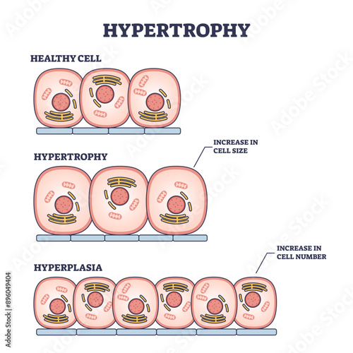 Hypertrophy, hyperplasia or healthy muscular cells comparison outline diagram, transparent background. Labeled educational scheme with increased cellular fluid after weight lifting.