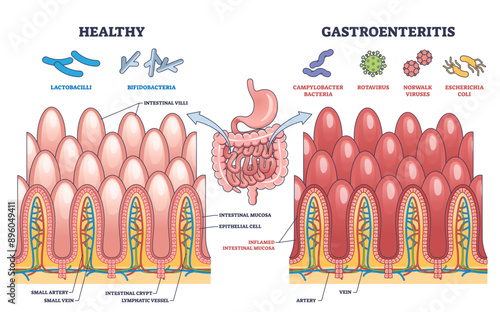 Gastroenteritis or stomach flu microbiological explanation outline diagram, transparent background. Labeled educational scheme with healthy and bacteria, rotavirus.