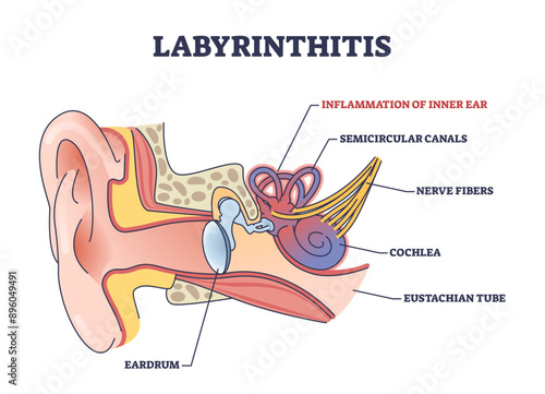 Labyrinthitis as inner ear infection and medical inflammation outline diagram, transparent background. Labeled educational scheme with painful condition and medical cause.