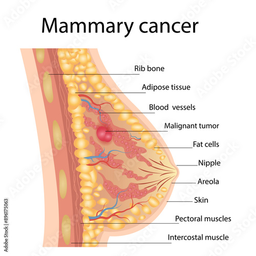 Breast cancer medical vector diagram with a cross-section of female breast anatomical structure and illustration of malignant breast tumor affected by cancer