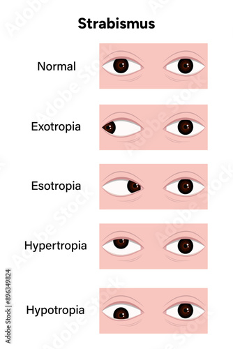 Eye problem disease strabismus normal Esotropia Exotropia Hypertropia Hypotropia