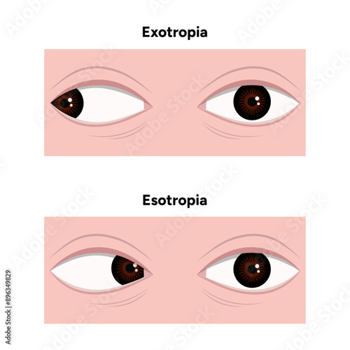 Eye problem disease strabismus Esotropia Exotropia 