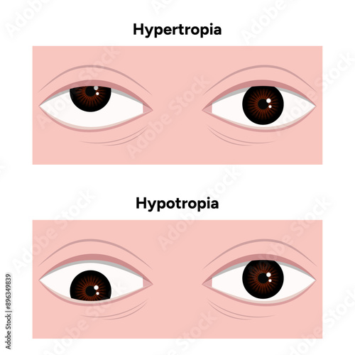 Eye problem disease strabismus Hypertropia Hypotropia