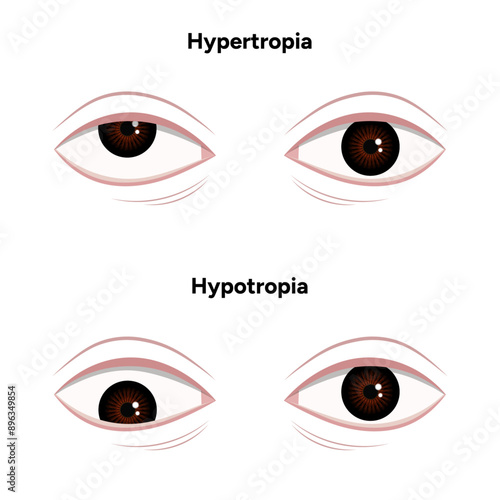 Eye problem disease strabismus Hypertropia Hypotropia