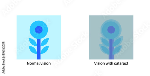 Cataract eye disease