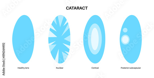 Cataract eye disease