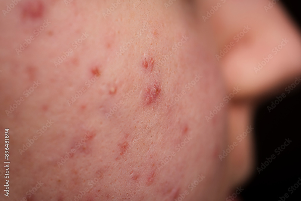 Skin acne background. Closeup acne pimple. Treatment for acne skin. Problem skincare. Pimples, acne, pores, scars. Natural skin. Skin care treatment. Pimples on face. Skin acne background. Closeup acne pimple. Treatment for acne skin. Problem skincare. Pimples, acne, pores, scars. Natural skin. Skin care treatment. Pimples on face.