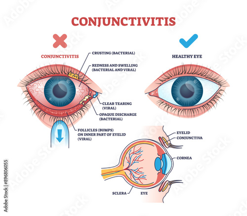 Conjunctivitis pink eye medical condition explanation outline diagram, transparent background. Labeled educational scheme with healthy lens comparison with virus.