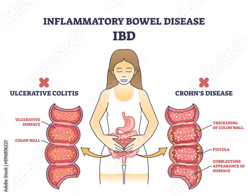 Inflammatory bowel disease or IBD with Crohns condition and ulcerative colitis outline diagram, transparent background. Labeled educational scheme.