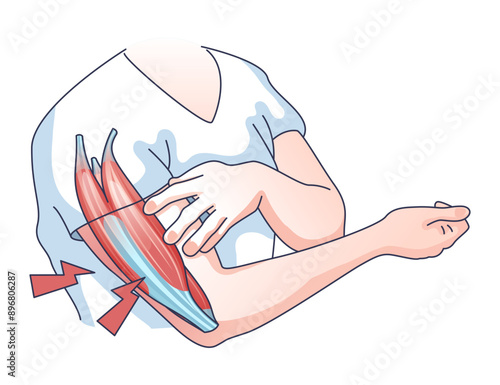 Muscle weakness with weak and fatigue muscular system outline concept, transparent background. Medical issue with physical disorder and arm cramps, exhaustion, pain or dystrophy illustration.