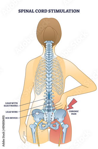 Spinal cord stimulation device for chronic back pain relief outline diagram, transparent background. Labeled educational scheme with medical procedure to help patients after spinal trauma.