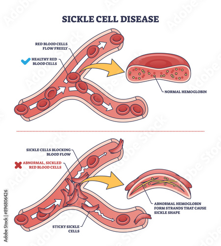 Sickle cell disease with abnormal red blood cell shape outline diagram, transparent background. Labeled educational scheme with medical disease and chronic vascular condition illustration.