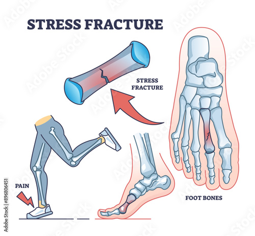 Stress fracture explanation with skeletal foot bone injury outline diagram, transparent background. Labeled educational scheme.
