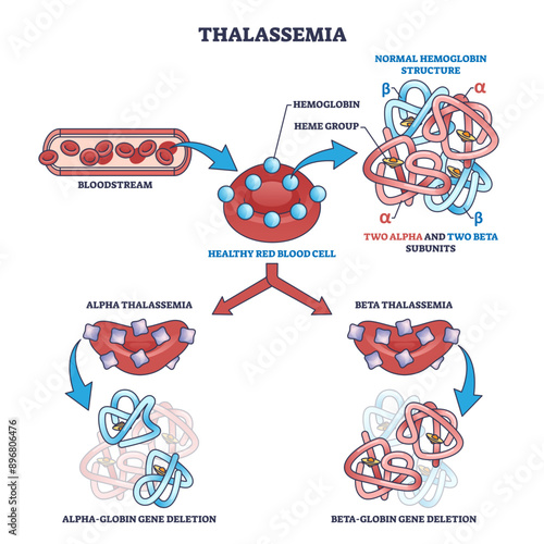 Thalassemia blood disease as hemoglobin structure deletion outline diagram, transparent background. Labeled educational scheme with alpha and beta globin subunits disorder illustration.