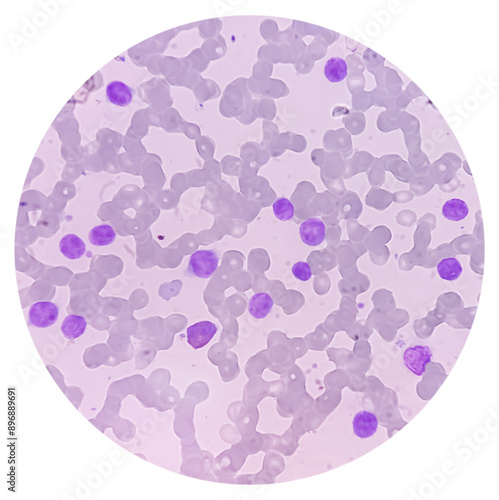 Bone marrow study smear picture of Acute Myeloid Leukemia, Blast cell, Granulopoiesis. Hematology. Blood cancer. photo