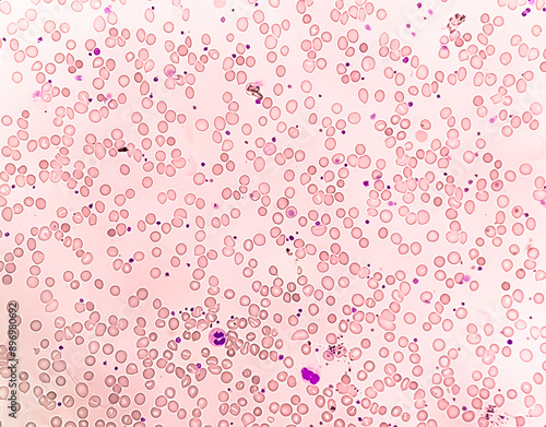 Anisocytosis anisochromia with both microcytic hypochromic and macrocytic hypochromic RBC with rouleaux formation, Dimorphic anemia.  photo