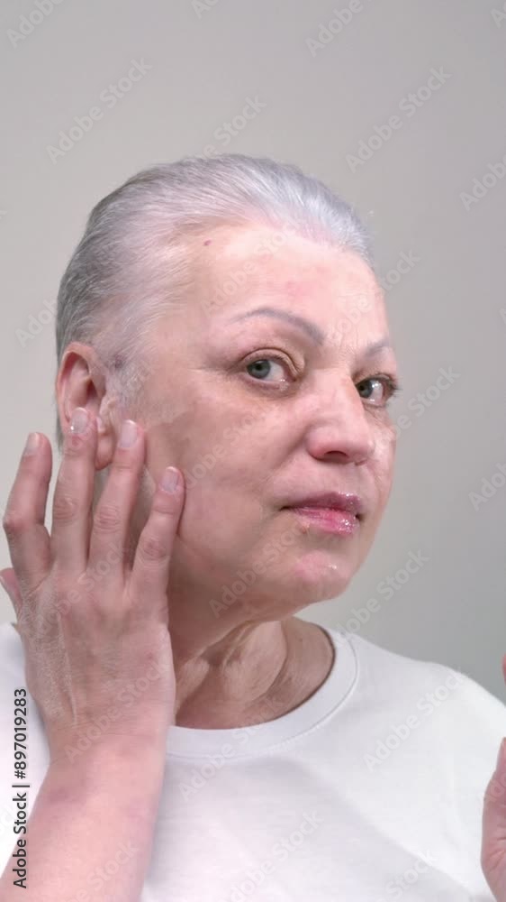 Gray-haired old woman with vitiligo on her face poses, shows pigmented spots on her head. Elderly female with short gray hair touches parts of her face with her hands and fingers with Melanin Gray-haired old woman with vitiligo on her face poses, shows pigmented spots on her head. Elderly female with short gray hair touches parts of her face with her hands and fingers with Melanin