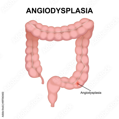 Angiodysplasia vascular abnormality in the GI tract
