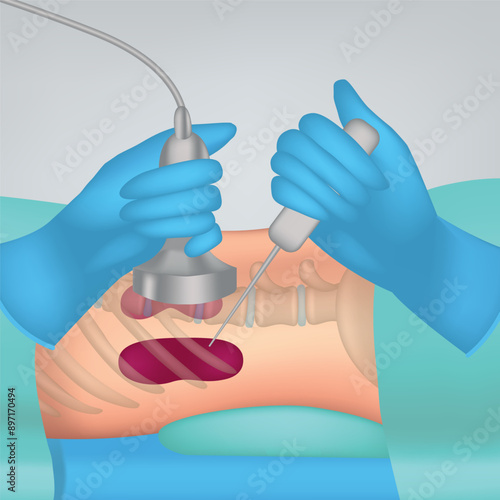 Kidney puncture. Visual illustration of the procedure with the patient and the doctor's hands. Medical poster. Vector illustration