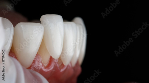 macro dental photo of a veneer with fitting on the lower jaw