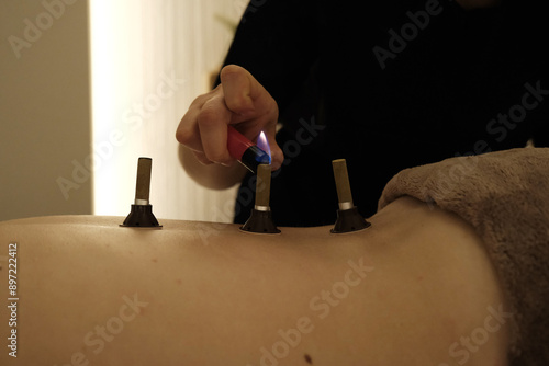 Photos Therapist doing moxa acupuncture treatment on back