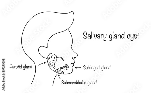 Salivary gland cyst